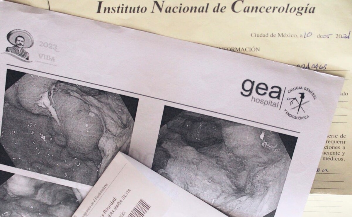 El cáncer de esófago afecta el conducto que conecta la garganta con el estómago. Foto: Especial