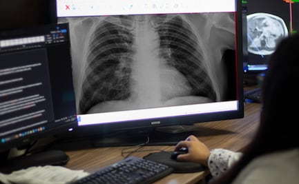 ¡Buenas noticias Toluca! El ISSEMYM lucha contra el cáncer de pulmón con nueva terapia