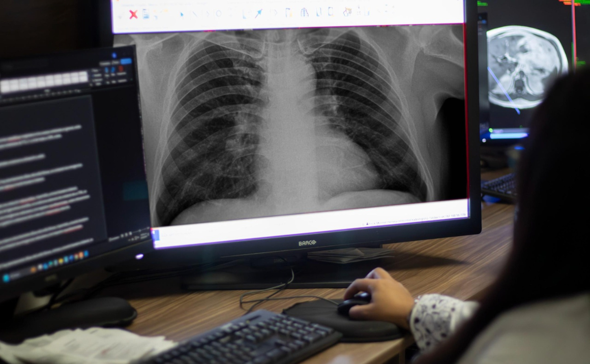 ¡Buenas noticias Toluca! El ISSEMYM lucha contra el cáncer de pulmón con nueva terapia