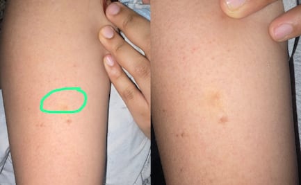 Joven sufre posible pinchazo en el Metro y denuncian ausencia de protocolo de seguridad