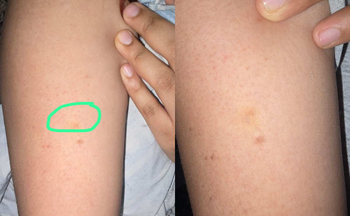 Michelle, la joven de 24 años que sufrió un presunto pinchazo en el Metro Chabacano. Foto: Especial