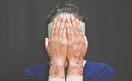 Buscan sanciones de hasta 58 años de cárcel por ataques con ácido en el Edomex