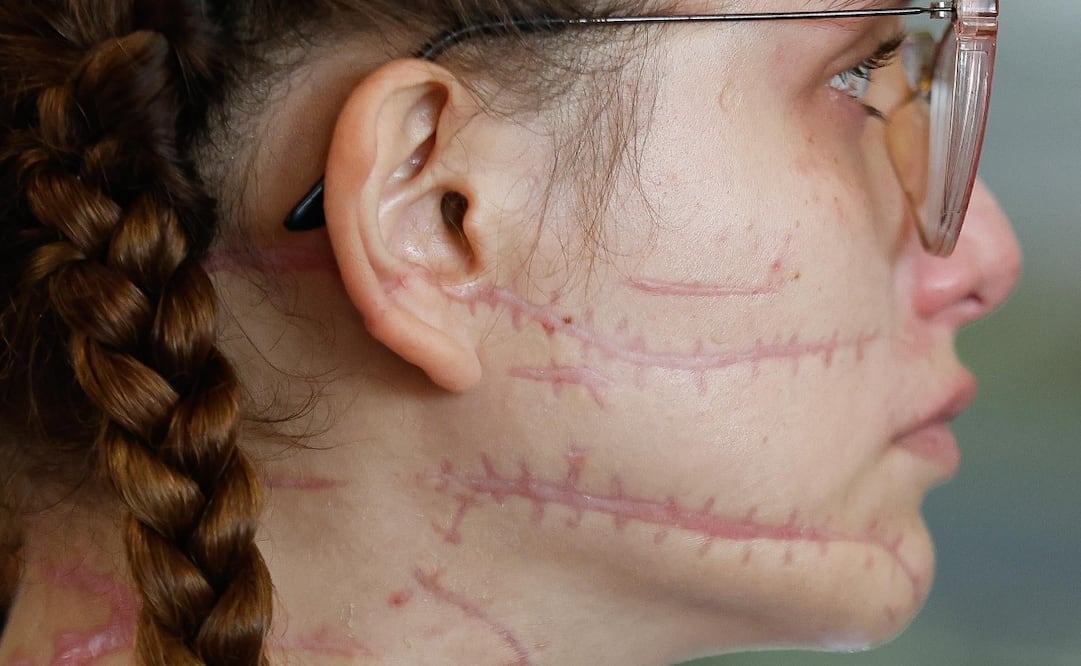 Wendy tiene secuelas graves. Perdió la movilidad del brazo derecho, sufre lesiones en las cuerdas vocales que le impiden alimentarse con normalidad y registra afecciones en distintos órganos. Foto. Diego Simón. El Universal